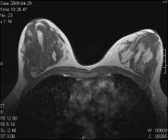 intraductalis papilloma fibrocystás változások