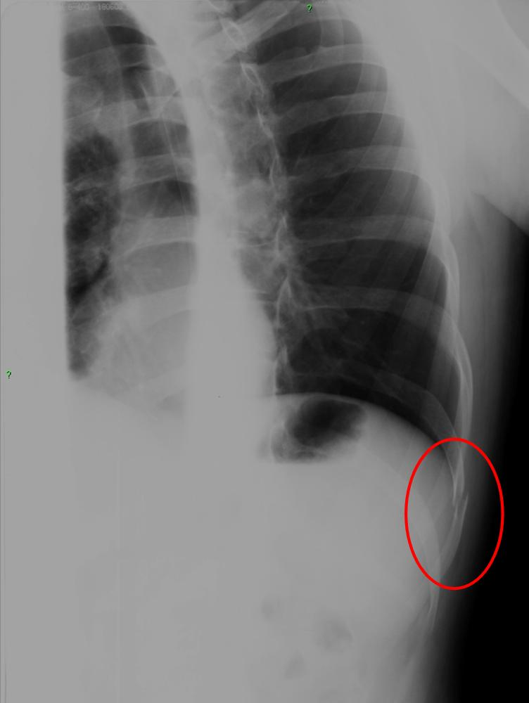Röntgensugár hogyan lehet fejlődni, Röntgenfelvétel terhesen: biztonságos?