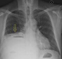 Tüdő mellhártyagyulladás az onkológiában - mi ez