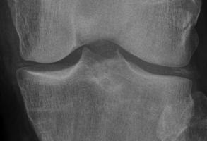 ízületi fájdalom az ágyékban a jobb térdízület deformáló osteoarthritisének kezelése
