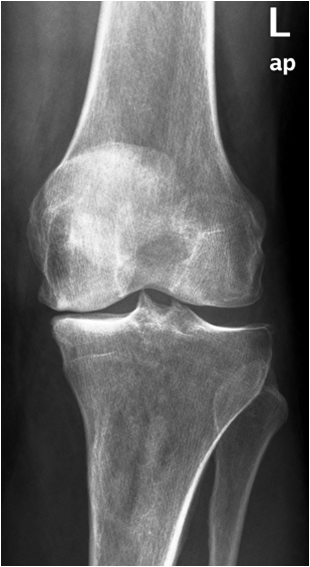 osteoarthritis generalizált forma