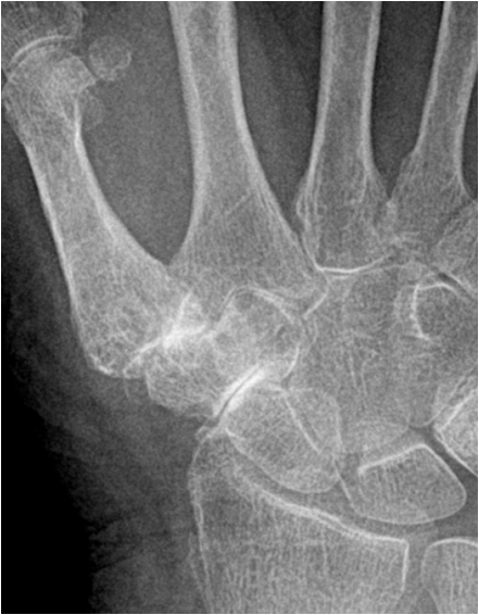 csontok és ízületek traumatikus sérülései radiológia