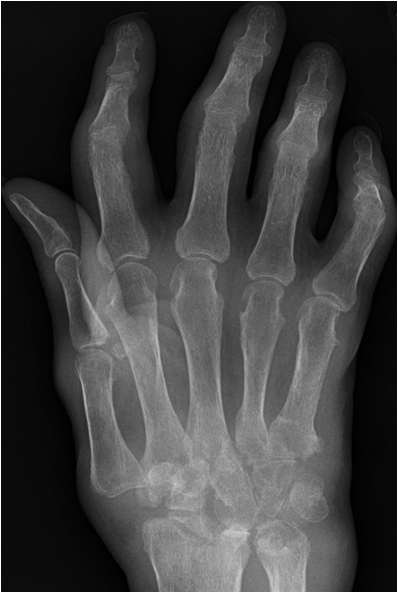 osteoarthritis generalizált forma kenőcsök rheumatoid arthritisre